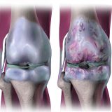 Lesão da cartilagem do joelho