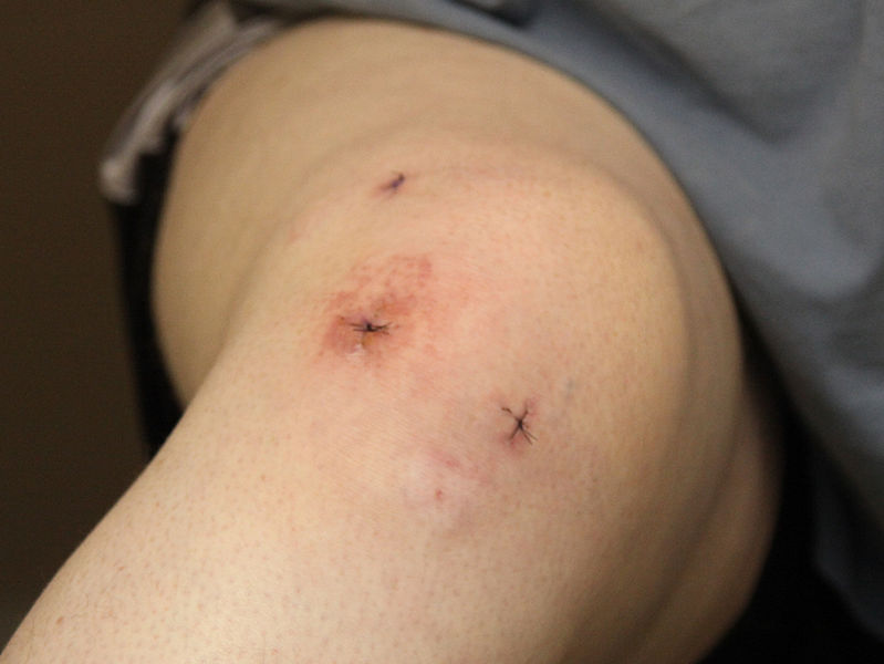 799px-Typical_arthroscopic_surgery_incisions_-_knee.jpg