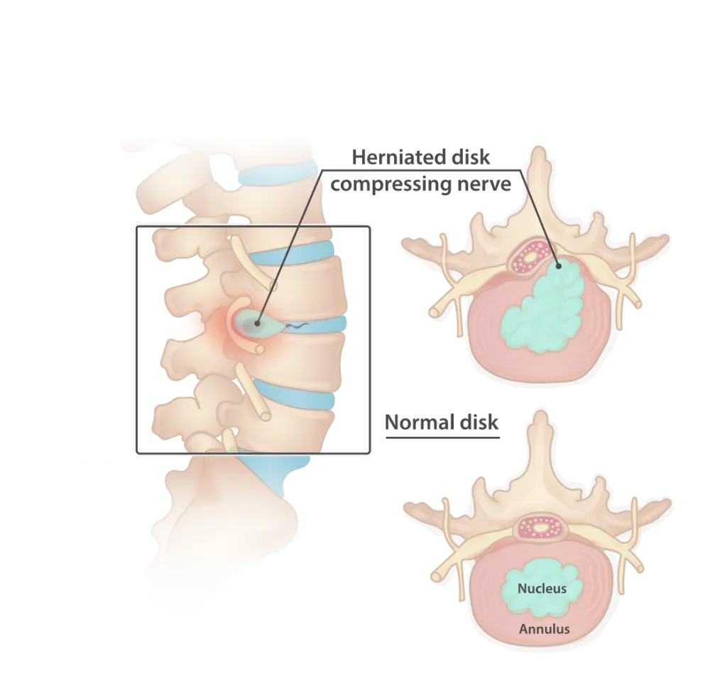 Disco Herniado