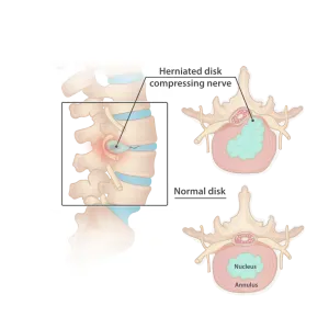 Disco Herniado